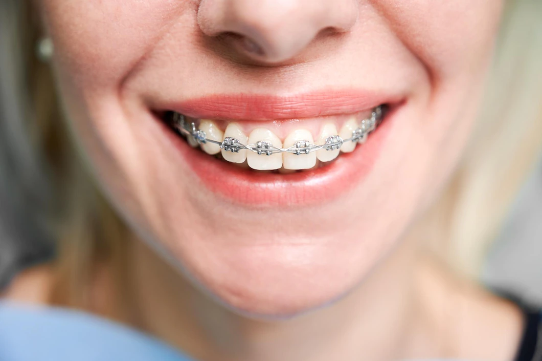 Orthodontic Treatment